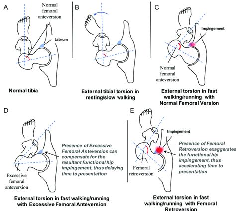 external tibial torsion test|femoral anteversion and tibial torsion.